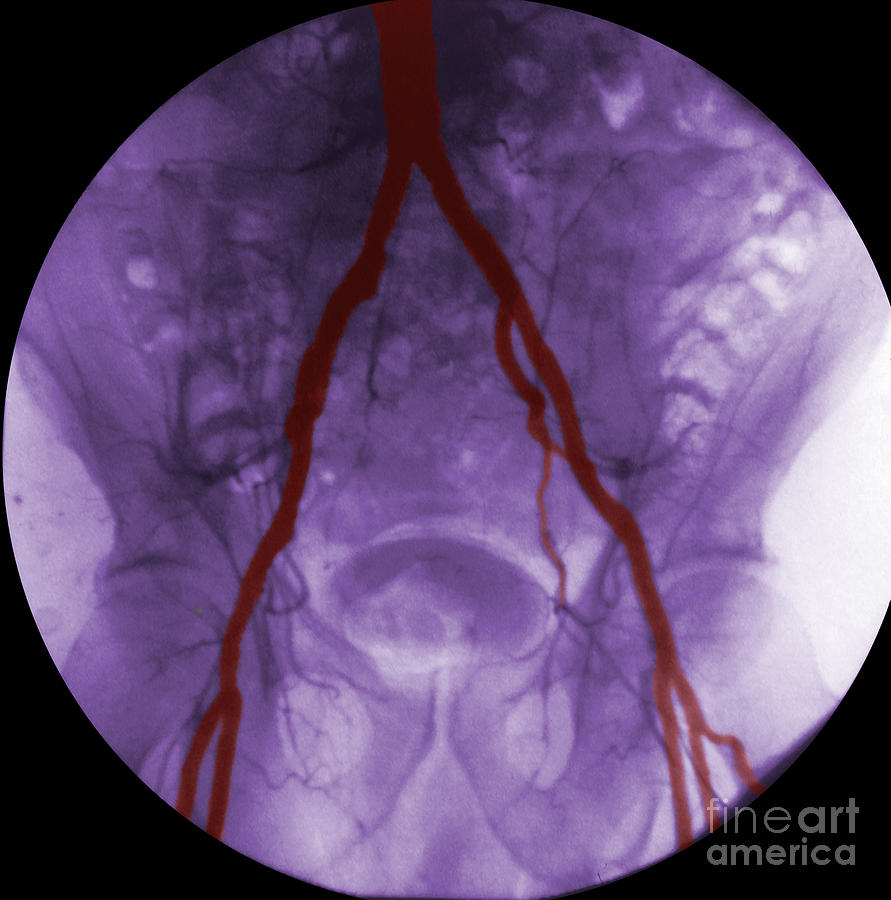 Angiogram Of Iliac Arteries Photograph by Omikron