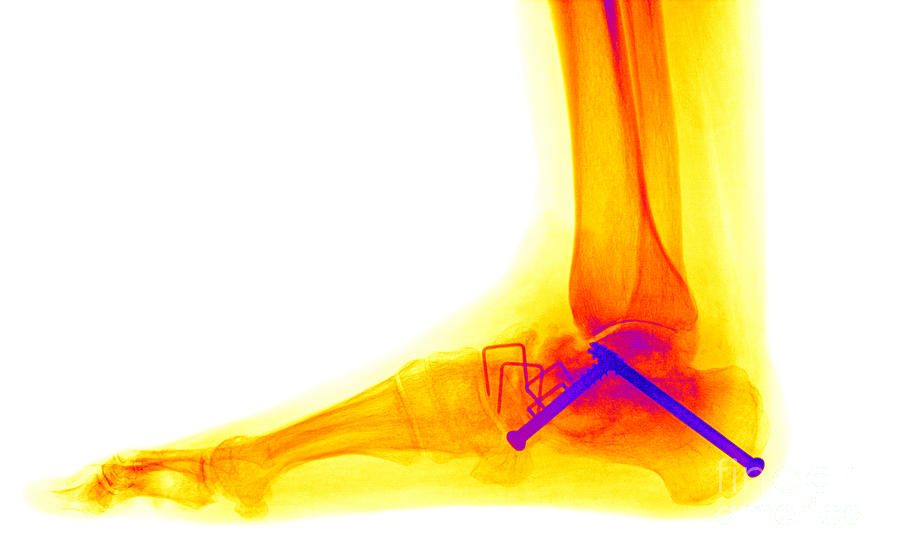 Ankle Fracture Photograph by Ted Kinsman