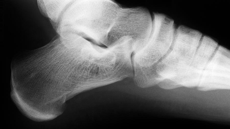 Ankle Joint, X-ray Photograph by Kaj R. Svensson - Fine Art America