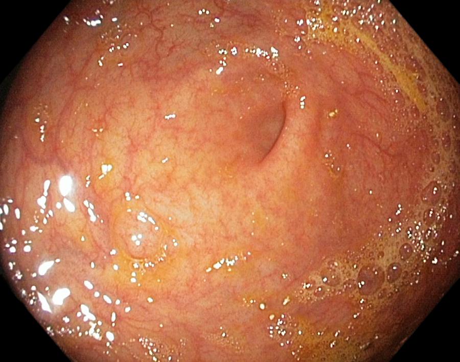 Endoscopy Photograph - Appendix Aperture In The Caecum by Gastrolab