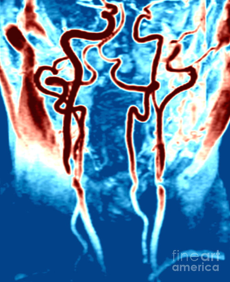 Arteries In The Upper Chest, Neck Photograph by Medical Body Scans