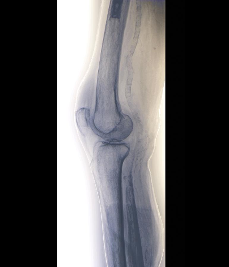 Human Photograph - Arteritis Of The Knee, X-ray by Zephyr