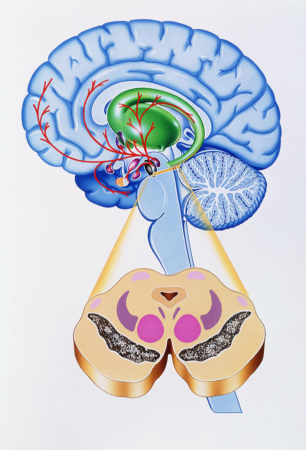 Artwork Of Brain Areas In Parkinson's Disease. Photograph ...