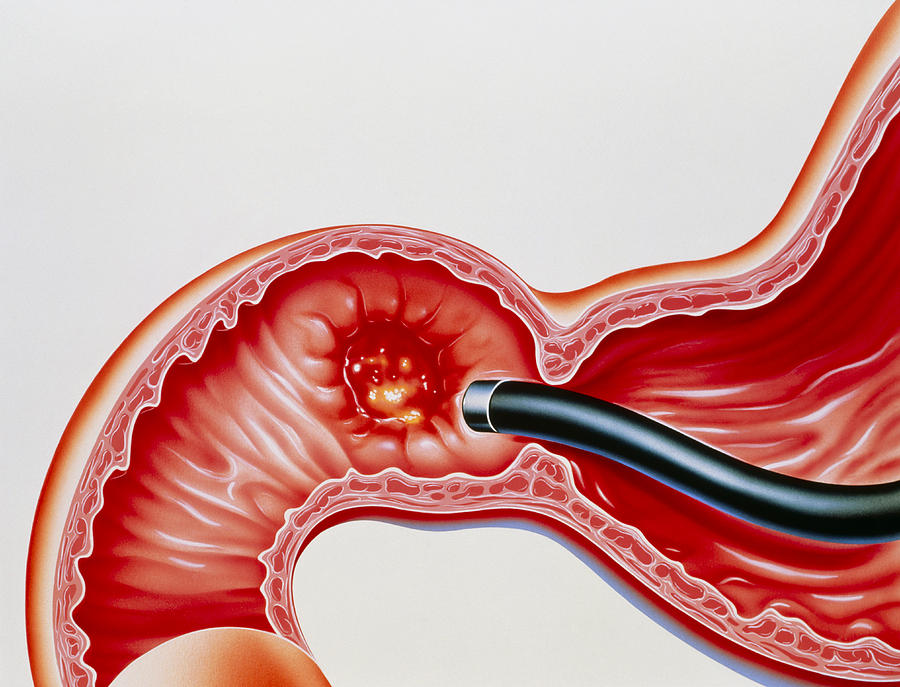 Peptic Ulcer Photograph - Artwork Of Duodenal Ulcer & Endoscope by John Bavosi