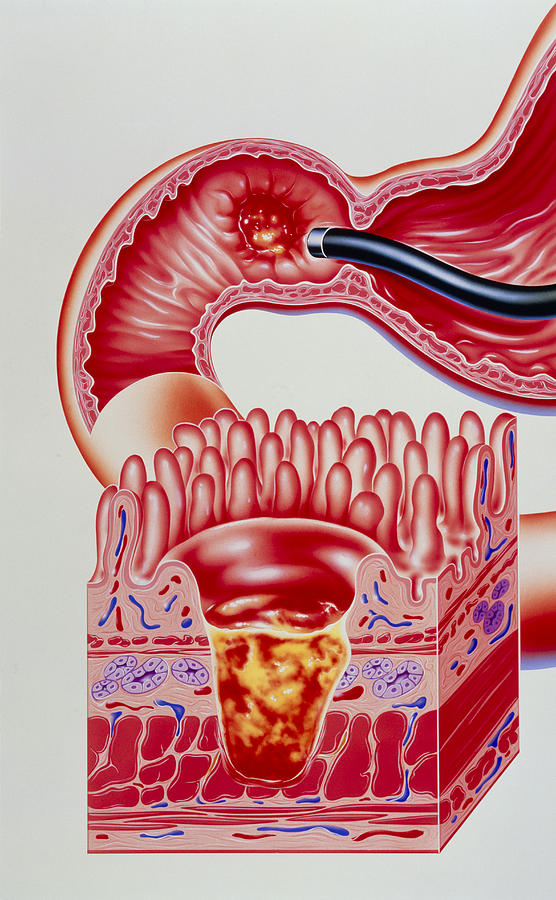 Peptic Ulcer Photograph - Artwork Of Duodenal Ulcer With Magnified View by John Bavosi