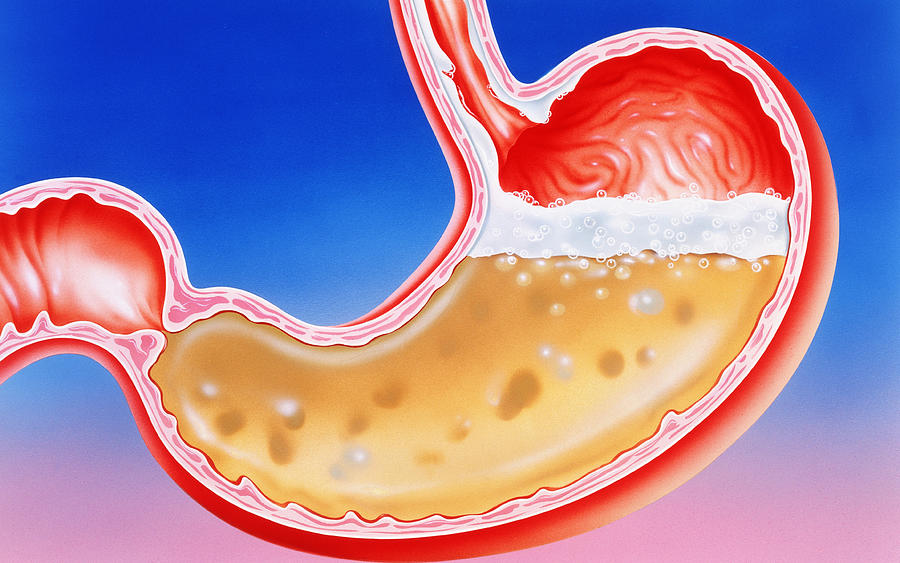 Artwork Of Heartburn (acid Indigestion) In Stomach Photograph by John ...