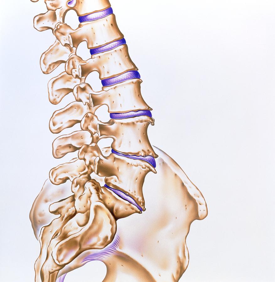 Artwork Of Osteoarthritis Of The Spine Photograph by John Bavosi