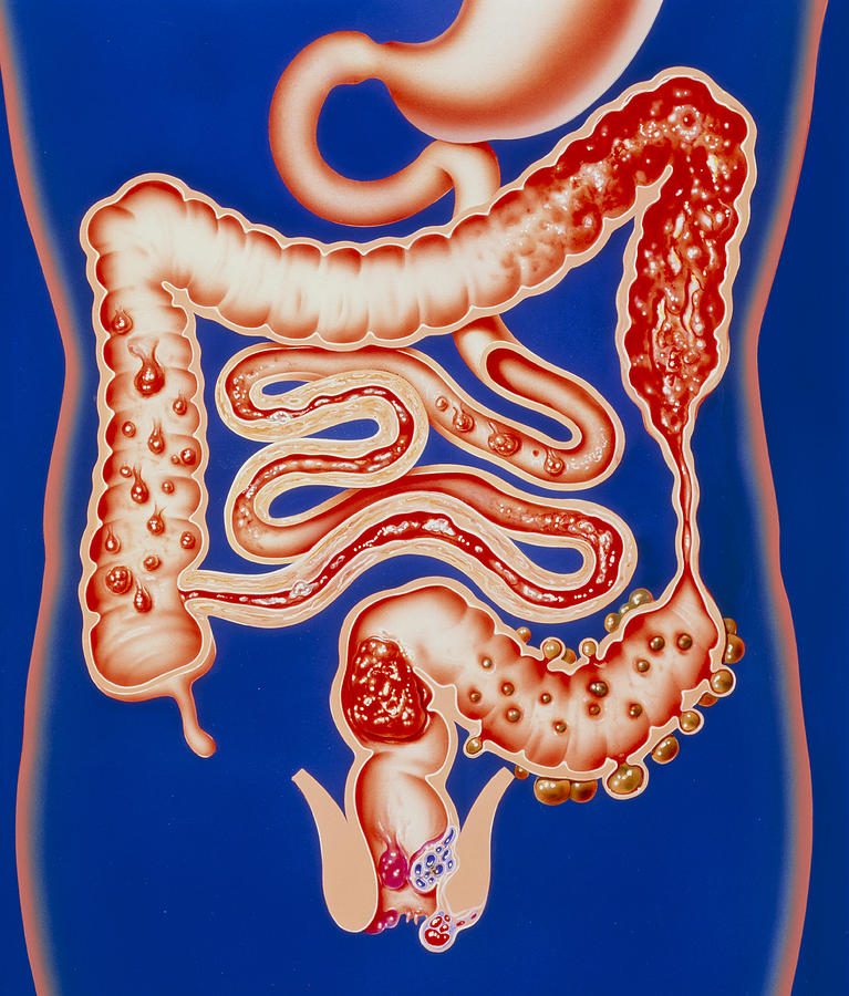 Haemorrhoid Photograph - Artwork Showing A Range Of Intestinal Diseases. by John Bavosi