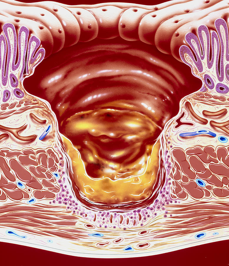 Ulcer Photograph - Artwork Showing Close-up Of Gastric Ulcer by John Bavosi