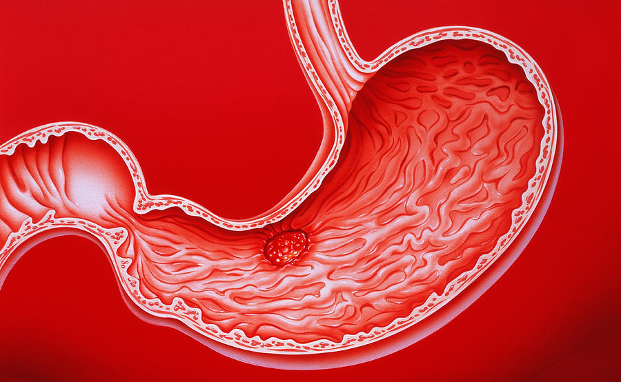 Ulcer Photograph - Artwork Showing Gastric Ulcer by John Bavosi