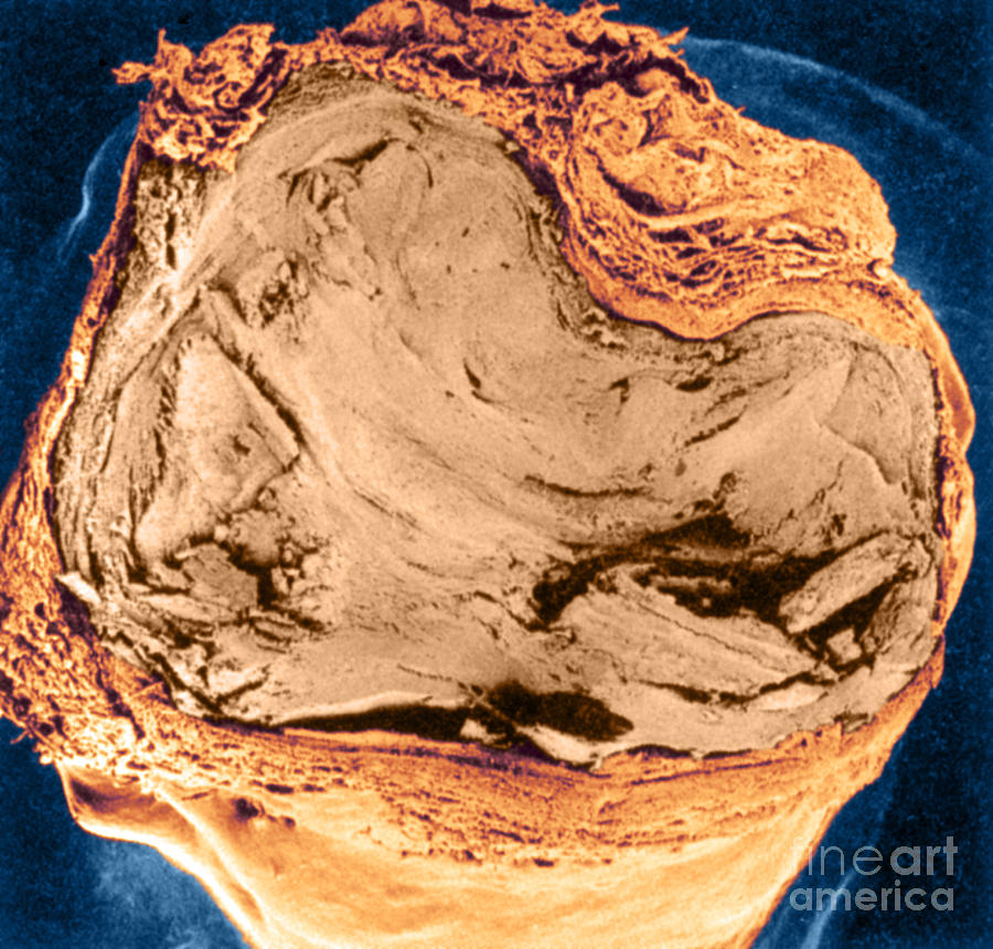 Atherosclerosis Sem, Full Blockage Photograph by Science Source