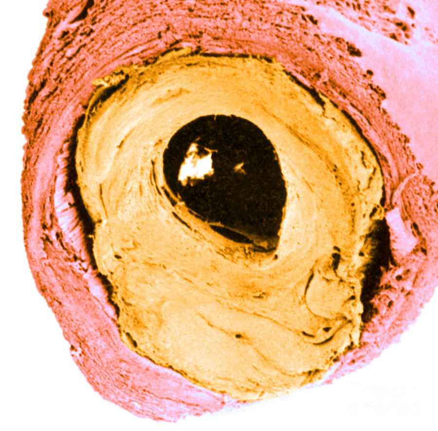 Atherosclerosis Sem, Partial Blockage Photograph by Science Source