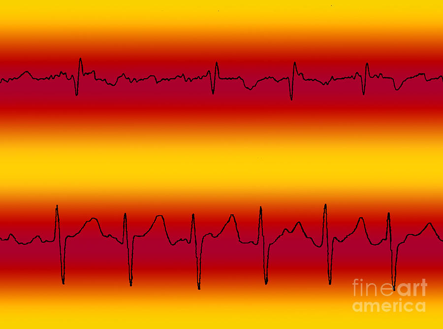 Atrial Flutter & Atrial Fibrillation Photograph by Science Source