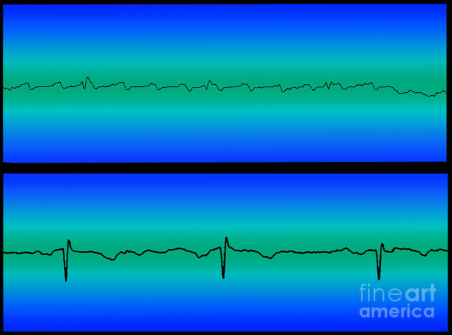 Atrial Flutter & Normal Heart Beat Photograph by Science Source