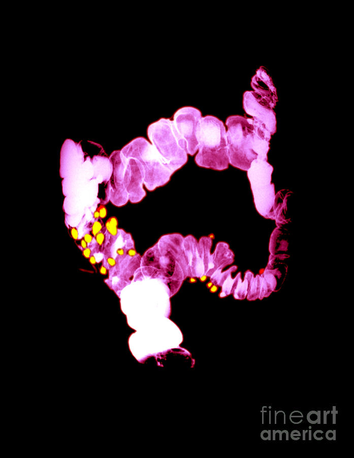 Barium Enema Showing Diverticulosis Photograph by Medical Body Scans