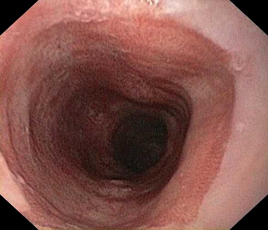 Endoscopy Photograph - Barretts Oesophagus Due To Reflux by Gastrolab