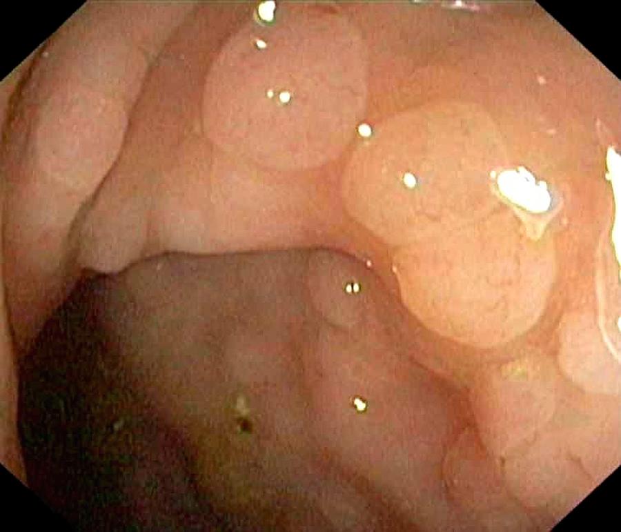 Endoscopy Photograph - Benign Polyps In The Rectum by Gastrolab