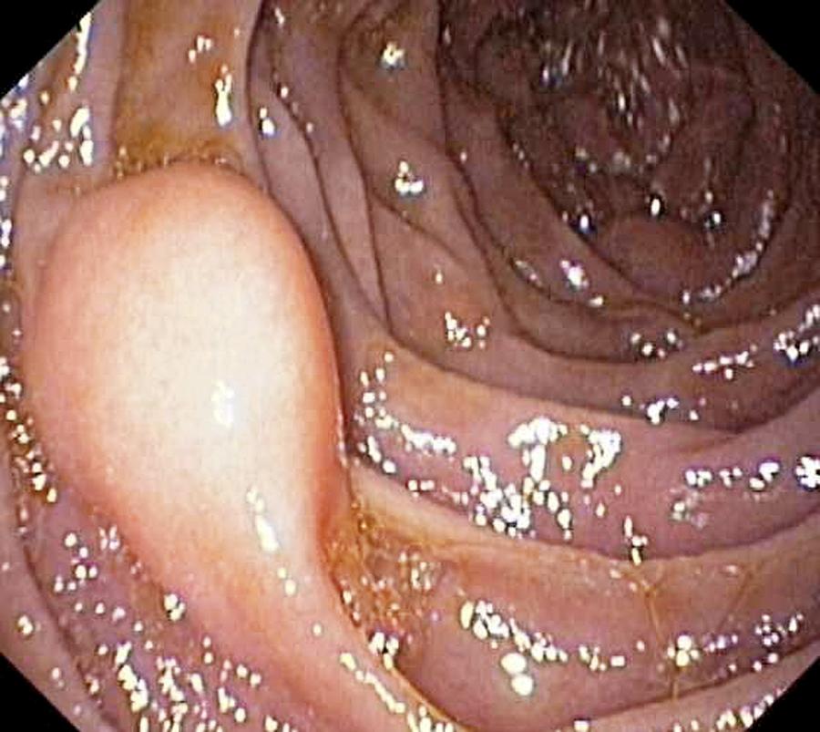 Lipoma Photograph - Benign Tumour Of The Small Intestine by Gastrolab