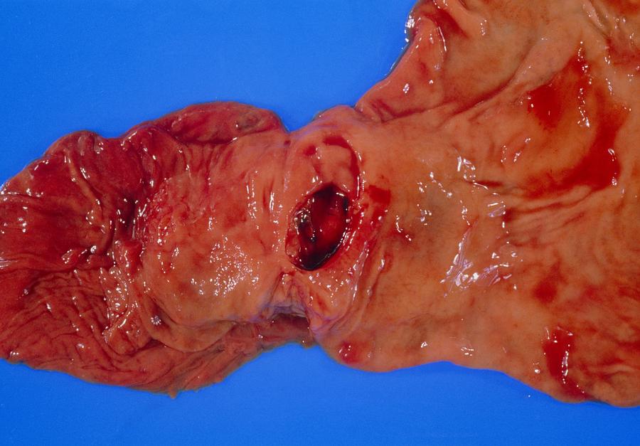 Gastric Ulcer Photograph - Bleeding Gastric Ulcer In Excised Part Of Stomach by Dr. E. Walker