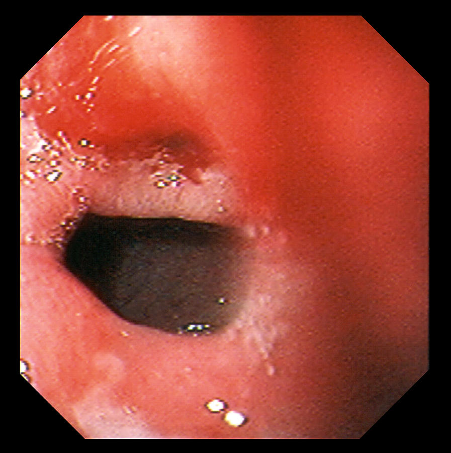 Small Intestines Photograph - Bleeding Intestinal Ulcer by David M. Martin, Md