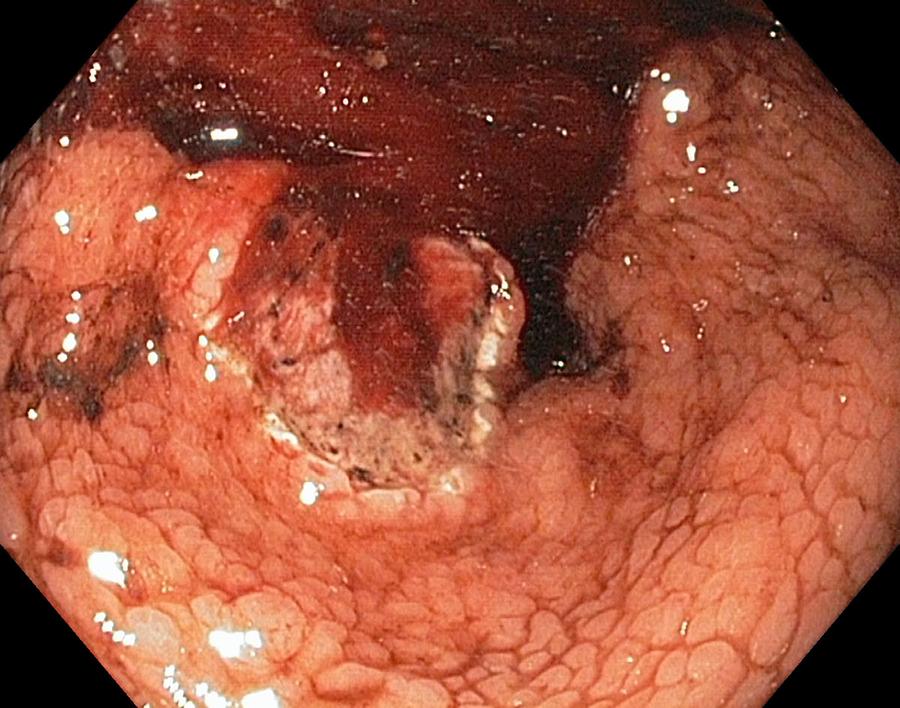 Endoscopy Photograph - Bleeding Stomach Ulcer With Cancer by Gastrolab