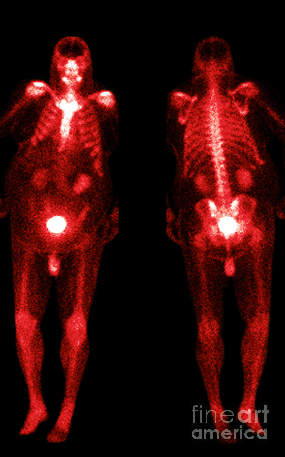Bone Scans Photograph by Medical Body Scans