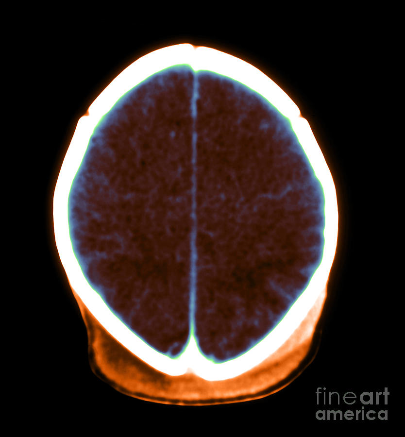 Brain Damage From Lack Of Oxygen Photograph by Medical Body Scans