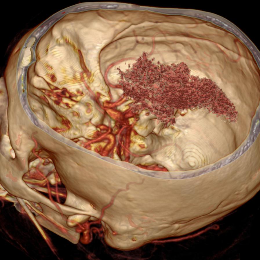 Brain Haemorrhage 3d Ct Scan Photograph By Du Cane Medical Imaging Ltd