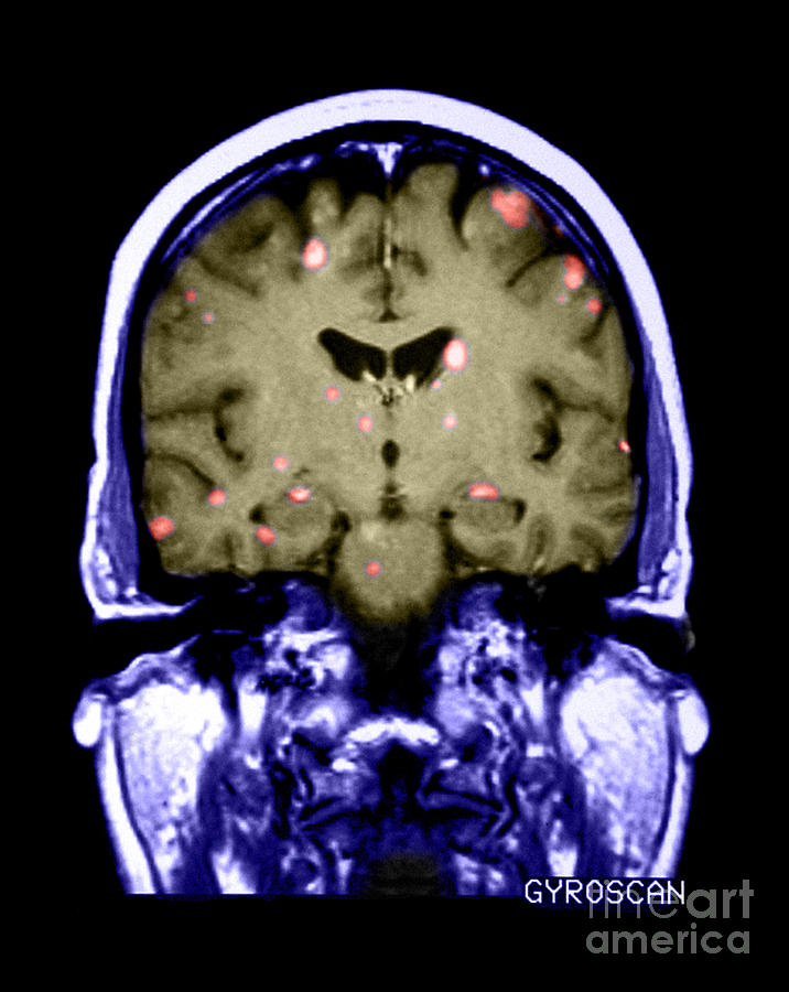 Brain Metastasis From Breast Cancer Photograph by Medical Body Scans