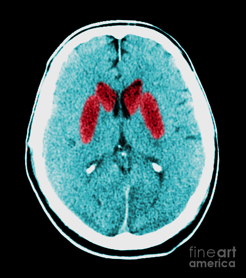Brain Of A Cardiac Arrest Victim Photograph by Medical Body Scans