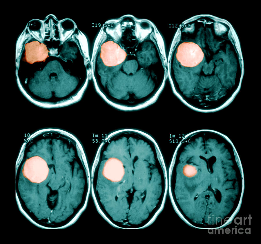 Brain Tumor Photograph by Medical Body Scans