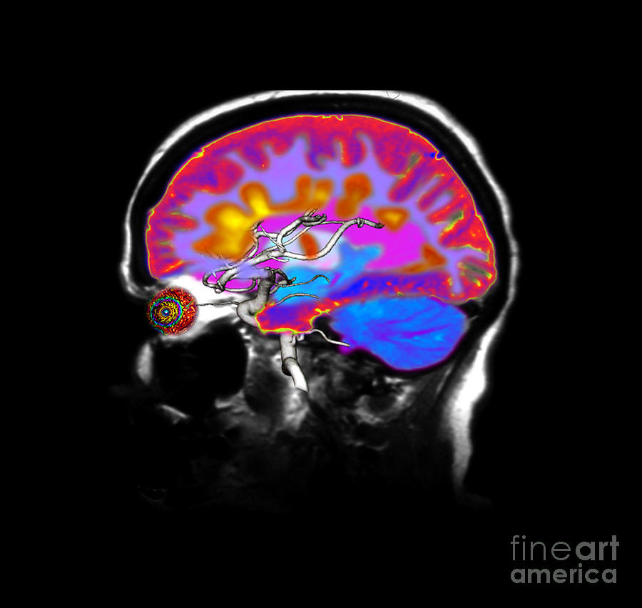 Brain With Multiple Sclerosis Photograph by Medical Body Scans