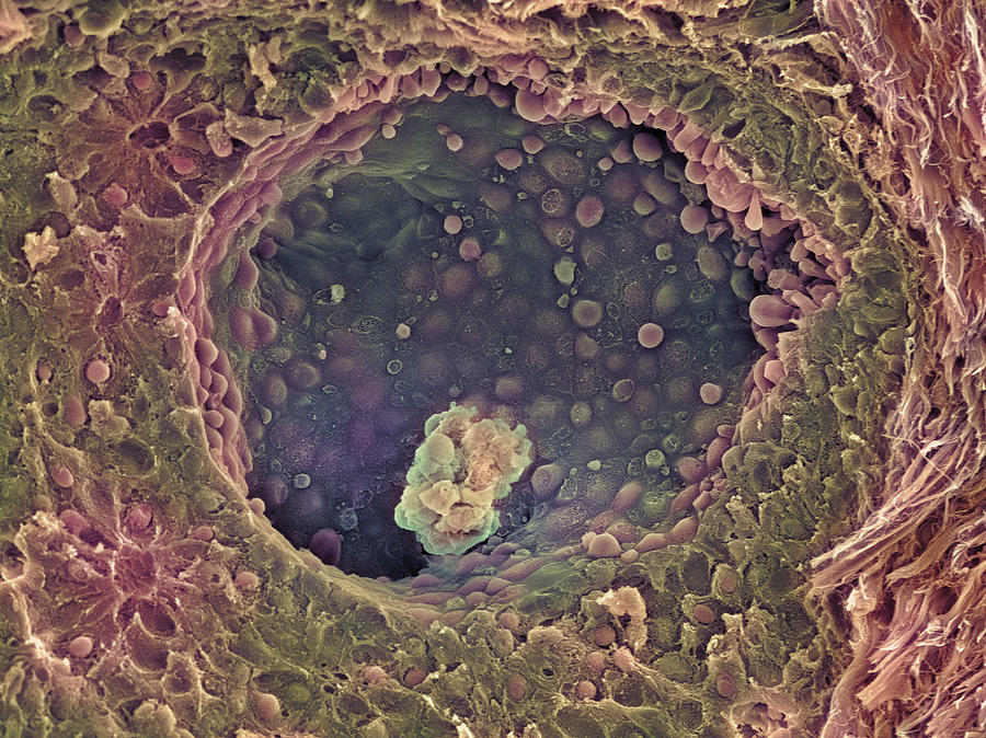 Breast Cancer Sem Photograph By Steve Gschmeissner Pixels