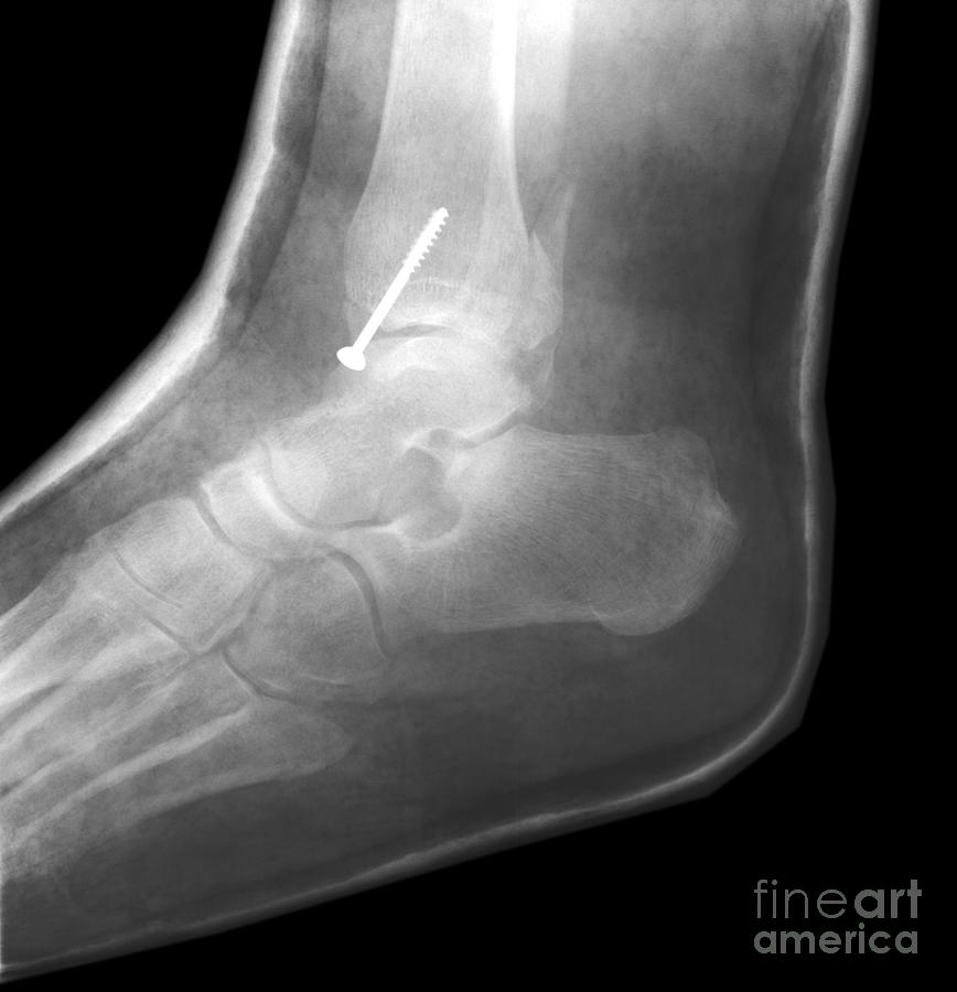 Broken Ankle Photograph by Ted Kinsman