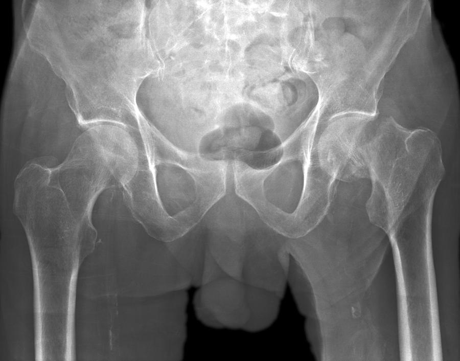 xray images of normal male hips