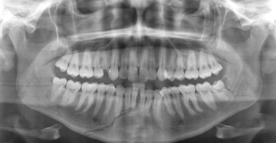 Broken Jawbone X Ray Photograph By Du Cane Medical Imaging Ltd Fine