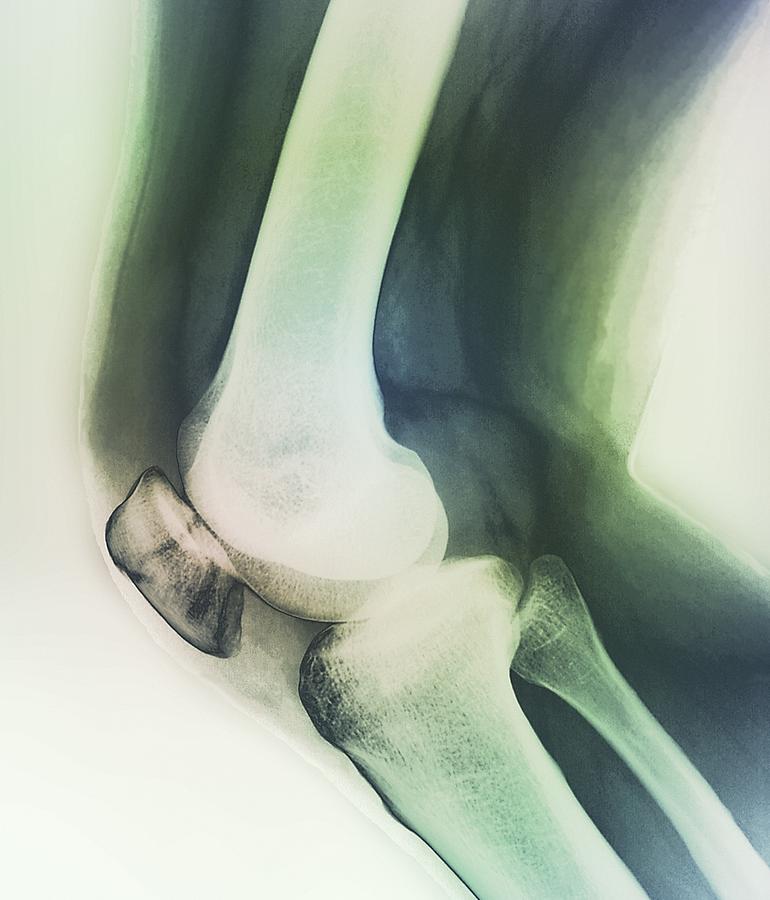 Broken Knee, X-ray Photograph by Zephyr.