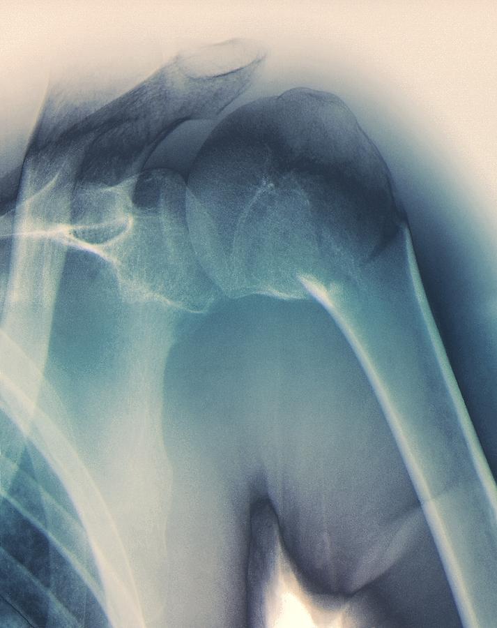 White Background Photograph - Broken Shoulder, X-ray by Zephyr