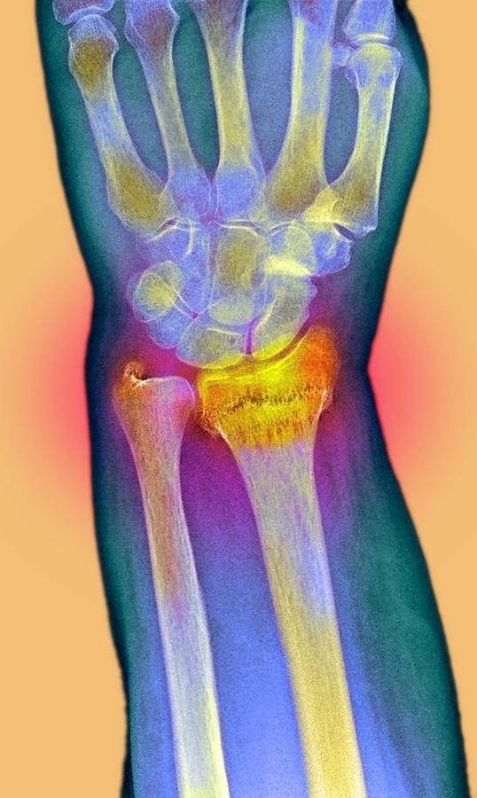 Broken Wrist, X-ray Photograph by Du Cane Medical Imaging Ltd - Fine ...