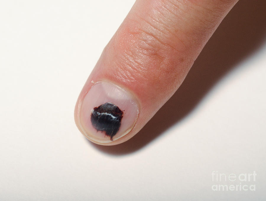 bruised-finger-photograph-by-photo-researchers-inc-fine-art-america