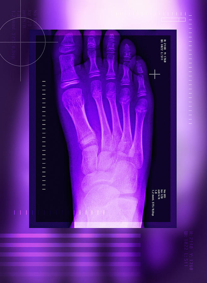 Bunion Photograph - Bunion After Surgery, X-ray by Miriam Maslo