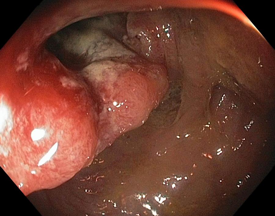 Endoscopy Photograph - Cancer Of The Colon And Rectum by Gastrolab