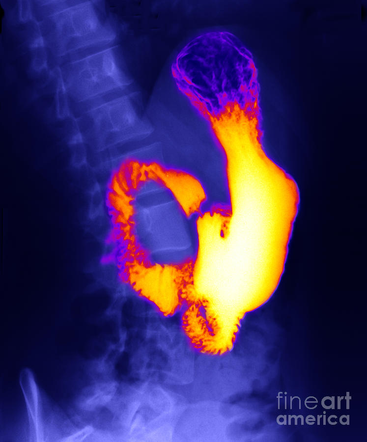 X-ray Photograph - Cancer by Ted Kinsman