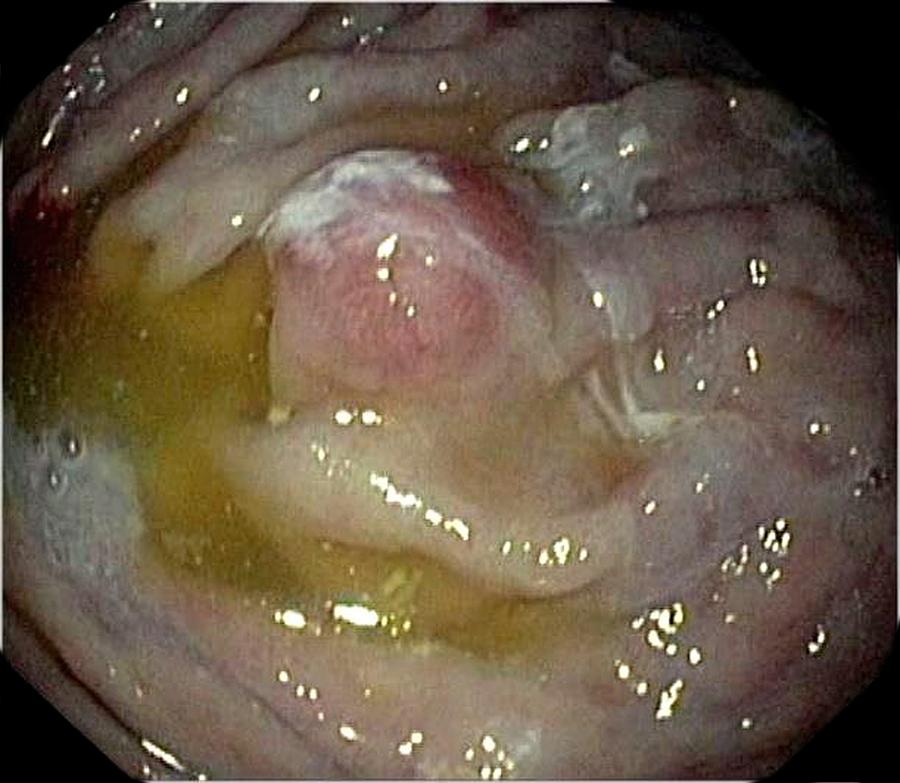 Endoscopy Photograph - Carcinoid Tumour In The Stomach by Gastrolab