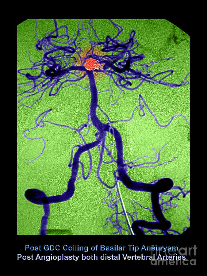 Abnormal Blood Vessel Photograph - Cerebral Angiogram by Medical Body Scans