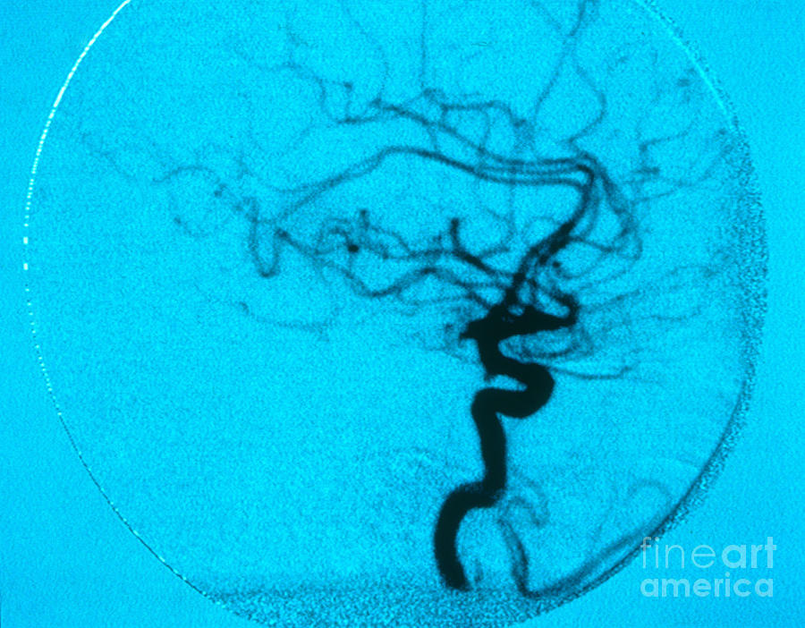 Cerebral Angiogram Photograph by Science Source