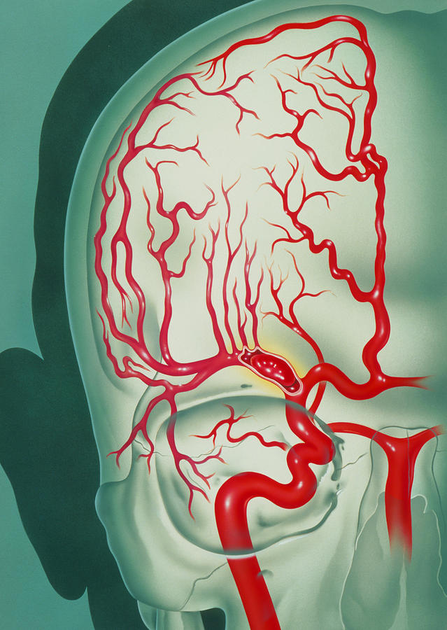 Cerebral Vascular Accident Cva Embolism Artwork Photograph By John Bavosi Fine Art America 6232