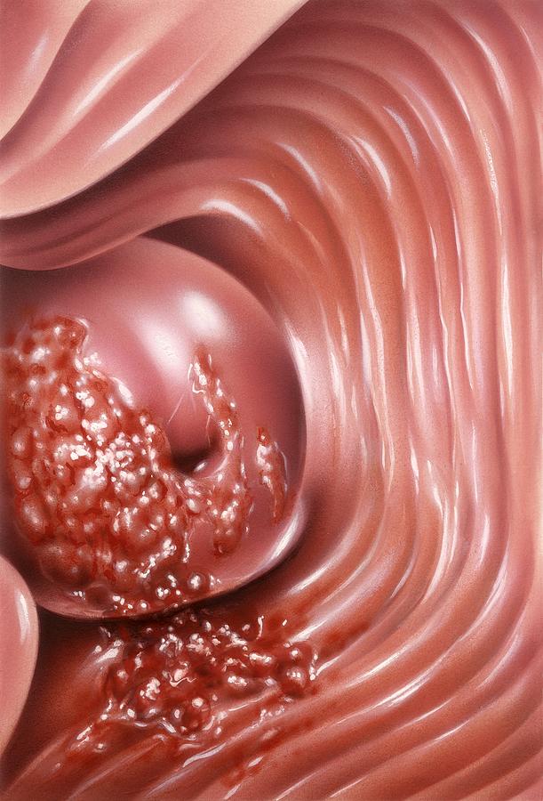 Disease Photograph - Cervical Cancer, Artwork by John Bavosi