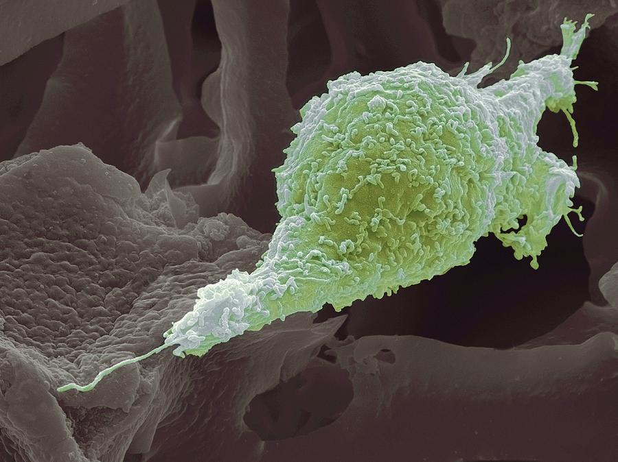 Cervical Cancer Cell, Sem Photograph by Steve Gschmeissner - Pixels