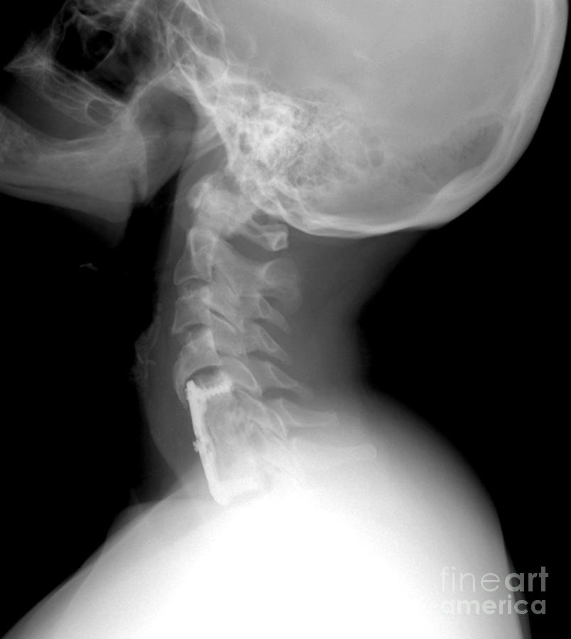 X-ray Photograph - Cervical Spine by Medical Body Scans